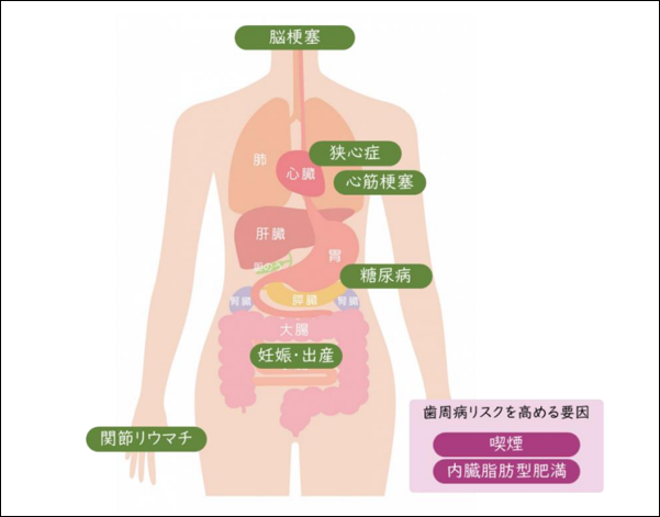 歯周病予防は生活習慣病予防にも効果的です
